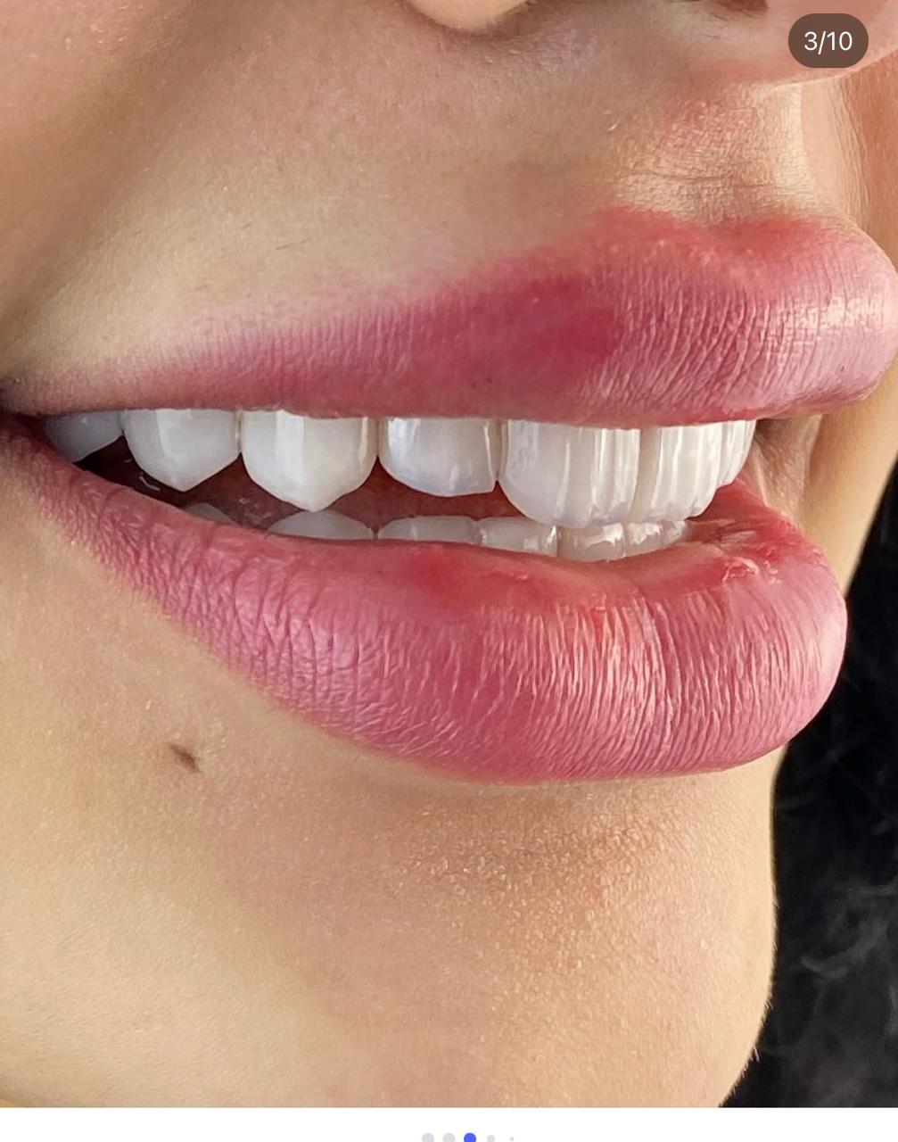 نتيجة علاج — تبييض وتجميل الأسنان — حالة ٣